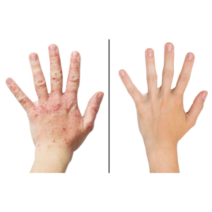 Zamavil Egzama ve Sedef İçin Afyon Termal Su Kürü