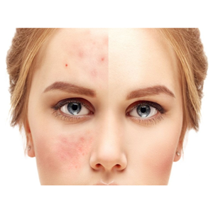 Zamavil Sivilce İçin Termal Su Kürü